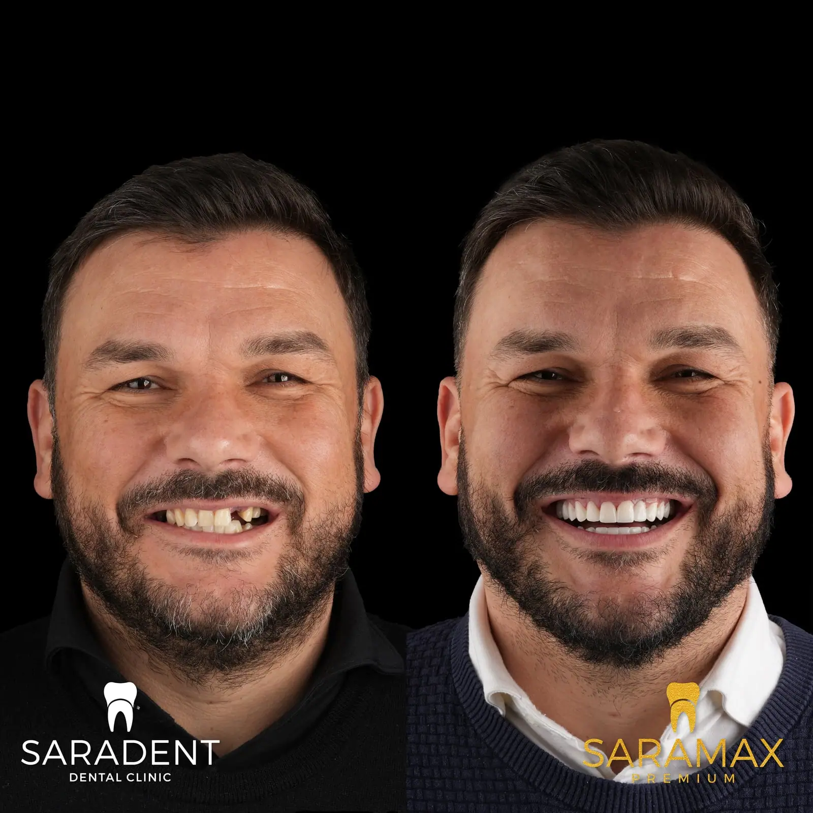 Muškarac srednjih godina prije i poslije SaraMax Premium rada – lijevo prije, s nedostajućim prednjim zubom, desno poslije
