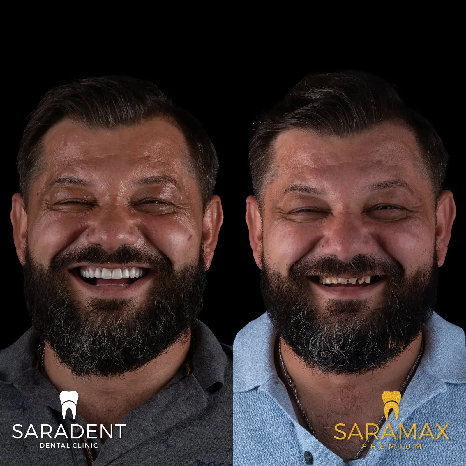 Muškarac s bradom prije i poslije SaraMax Premium rada – lijevo poslije, desno prije, s oštećenim zubima